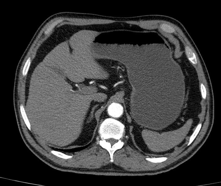 File:Abdominal aortic aneurysm (Radiopaedia 22421-22458 C+ arterial phase 7).jpg