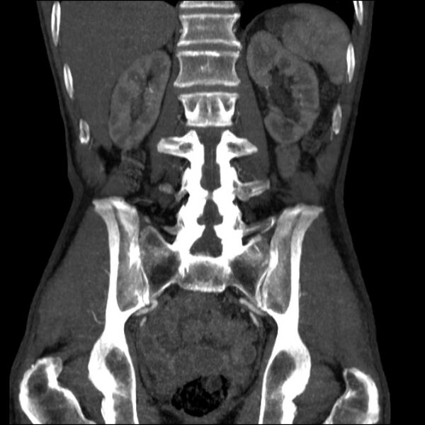 File:Abdominal aortic aneurysm (Radiopaedia 23703-23856 Coronal C+ arterial phase 24).jpg