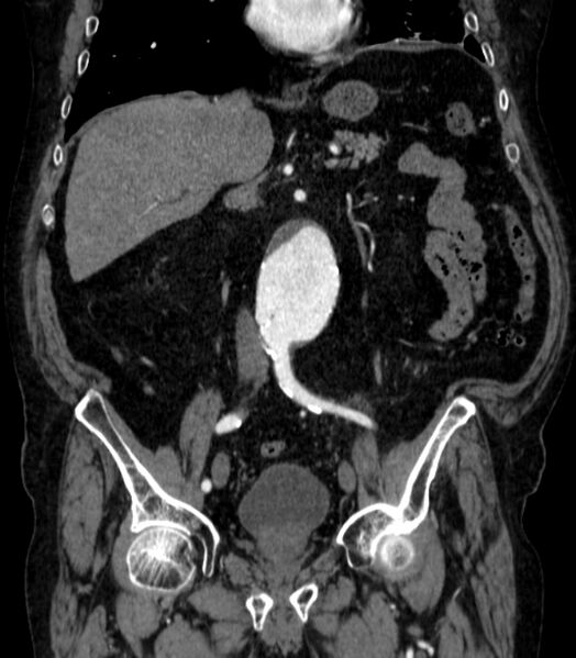 File:Abdominal aortic aneurysm (Radiopaedia 25855-26001 Coronal C+ arterial phase 29).jpg