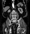 Abdominal aortic aneurysm (Radiopaedia 25855-26001 Coronal C+ arterial phase 54).jpg