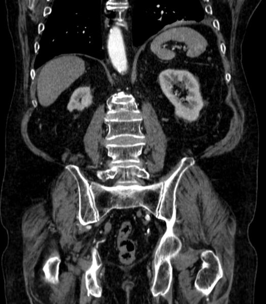 File:Abdominal aortic aneurysm (Radiopaedia 25855-26001 Coronal C+ arterial phase 54).jpg