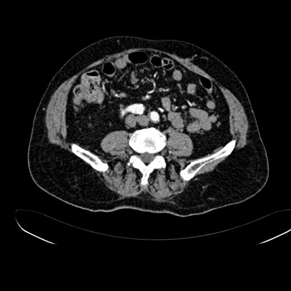 File:Abdominal aortic aneurysm (Radiopaedia 75131-86203 Axial C+ arterial phase 29).jpg