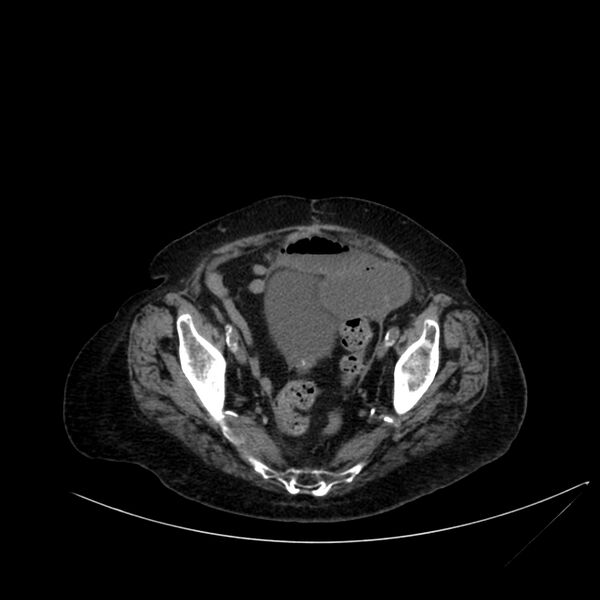File:Abdominal aortic aneurysm - impending rupture (Radiopaedia 19233-19246 Axial non-contrast 105).jpg