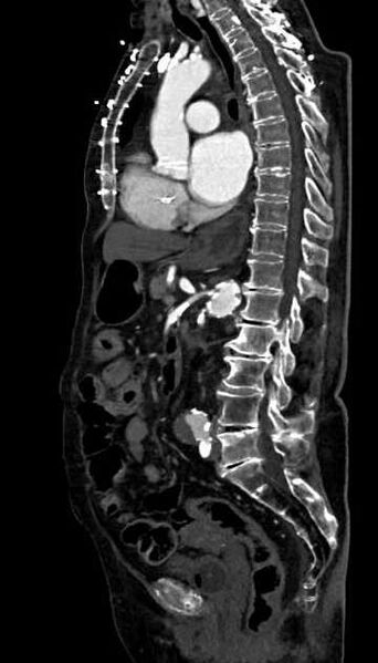 File:Abdominal aortic aneurysm with thrombus fissuration (Radiopaedia 73192-83919 Sagittal C+ arterial phase 65).jpg