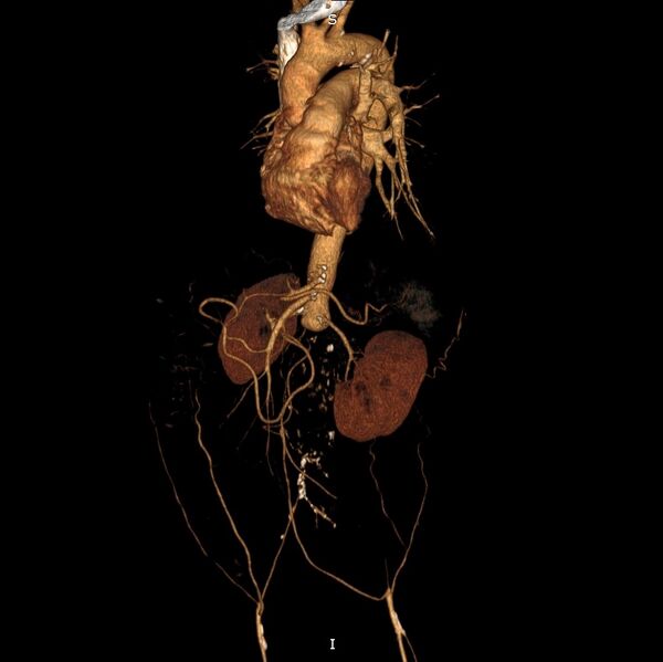 File:Abdominal aortic interposition tube graft and aneurysm thrombosis (Radiopaedia 71438-81857 3D VRT C+ arterial phase 3).jpg