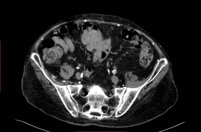 Abdominal aortic interposition tube graft and aneurysm thrombosis (Radiopaedia 71438-81857 Axial C+ arterial phase 162).jpg