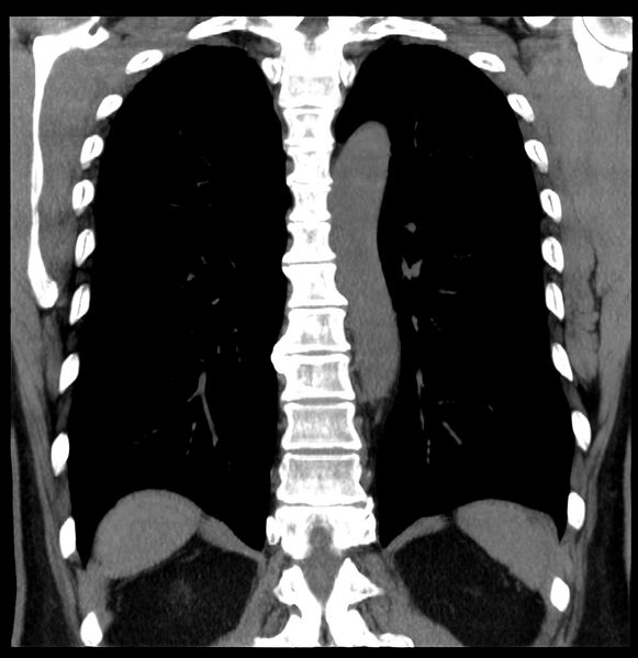 File:Aberrant right subclavian artery (Radiopaedia 40967-43680 Coronal non-contrast 30).jpg