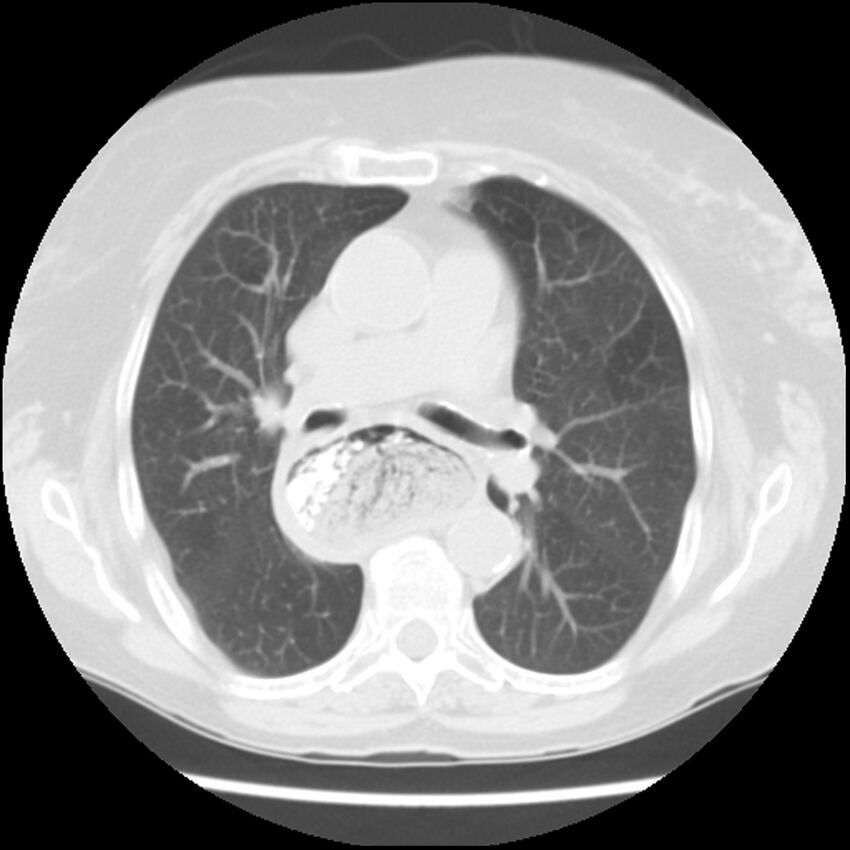 Achalasia (Radiopaedia 44094-47649 Axial lung window 26).jpg