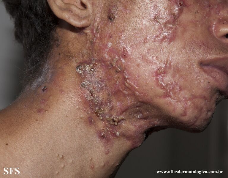 File:Acne Fulminans (Dermatology Atlas 13).jpg
