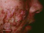 Acne conglobata (DermNet NZ acne-conglobata).jpg