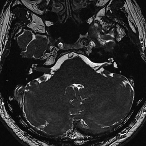 File:Acoustic schwannoma - intracanalicular (Radiopaedia 9937-10504 Axial T2 1).jpg