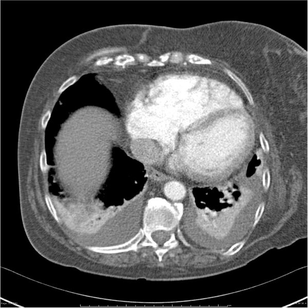 File:Acute-on-chronic pulmonary emboli (Radiopaedia 27925-28169 C+ CTPA 58).jpg