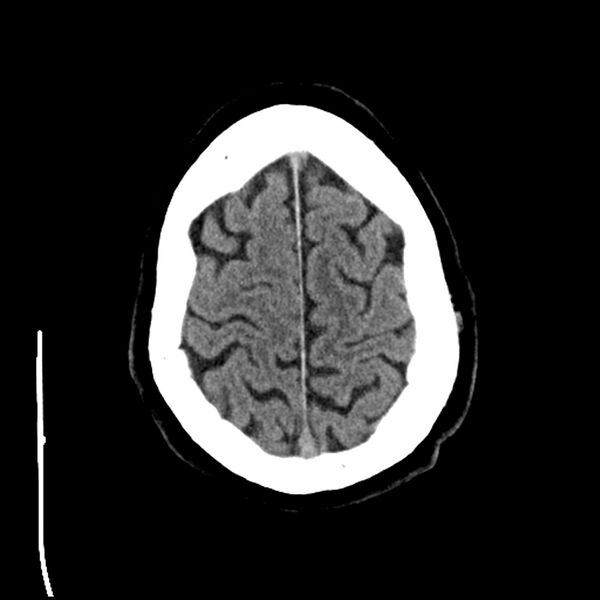 File:Acute A3 occlusion with ACA ischemic penumbra (CT perfusion) (Radiopaedia 72036-82525 Axial non-contrast 39).jpg