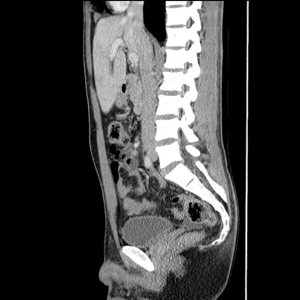File:Acute appendicitis (Radiopaedia 27049-27227 Sagittal C+ portal venous phase 37).jpg