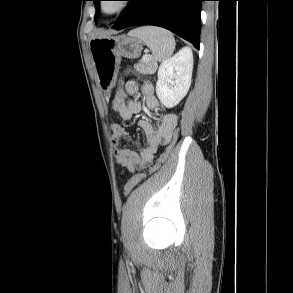 File:Acute appendicitis (Radiopaedia 27049-27227 Sagittal C+ portal venous phase 62).jpg