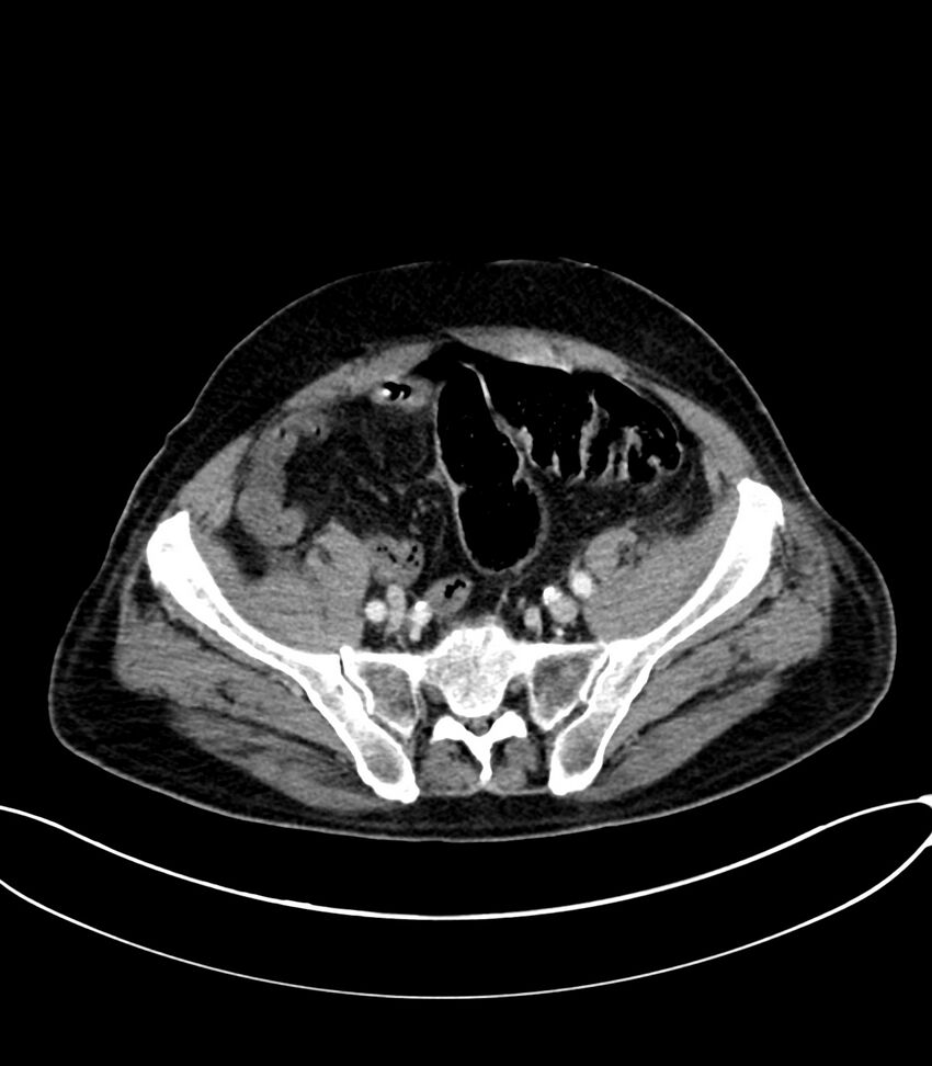 Acute arterial mesenteric ischemia (Radiopaedia 78238-90828 Axial C+ portal venous phase 110).jpg