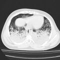 Acute aspiration pneumonitis (Radiopaedia 33605-34703 Axial lung window 68).jpg