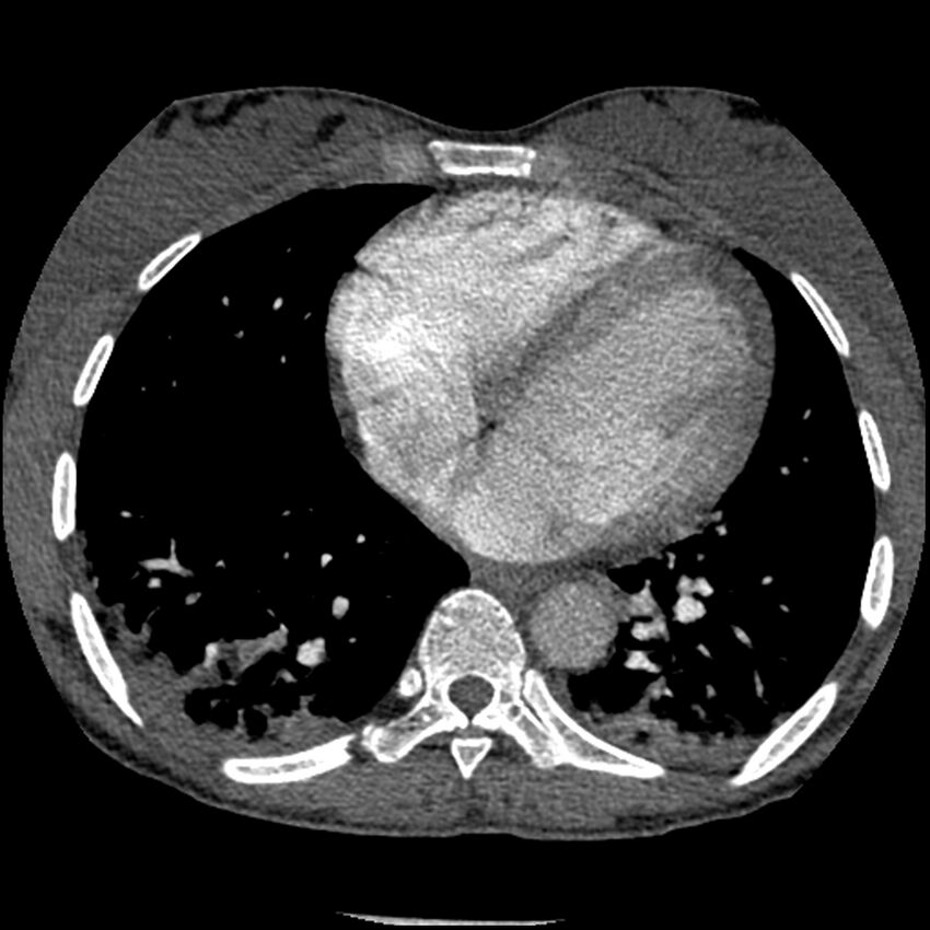 Acute chest syndrome - sickle cell disease (Radiopaedia 42375-45499 Axial C+ CTPA 126).jpg
