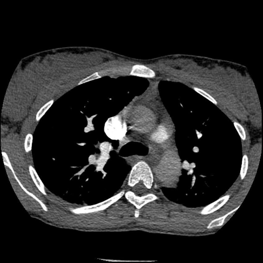 Acute chest syndrome - sickle cell disease (Radiopaedia 42375-45499 Axial C+ CTPA 65).jpg