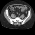 Acute cholecystitis and ureteric colic (Radiopaedia 42330-45444 Axial prone 76).jpg