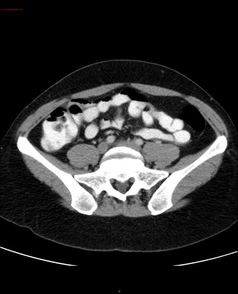 File:Acute gastritis (Radiopaedia 21043-20975 Axial C+ portal venous phase 46).jpg