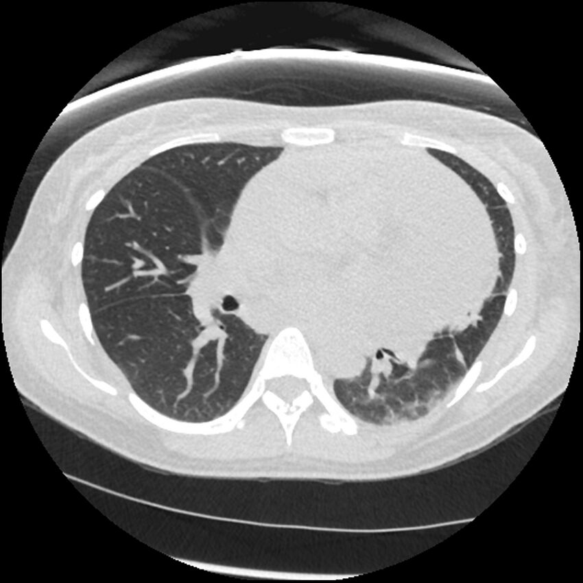 Acute lupus nephritis (Radiopaedia 45832-50107 Axial lung window 45).jpg