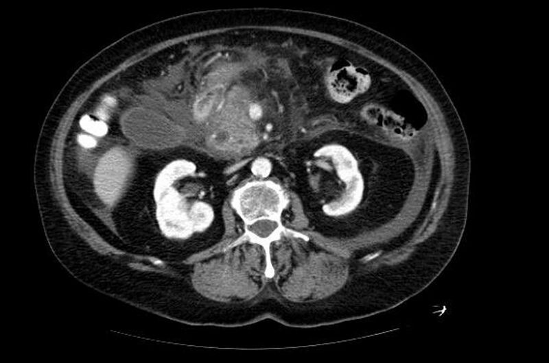 File:Acute pancreatitis (Radiopaedia 11163-11528 Axial 4).jpg