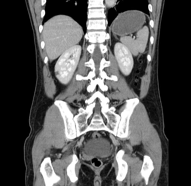 File:Acute pancreatitis (Radiopaedia 22572-22596 Coronal C+ portal venous phase 40).jpg