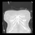 Acute pulmonary edema on CT (Radiopaedia 33582-34672 Coronal lung window 1).jpg