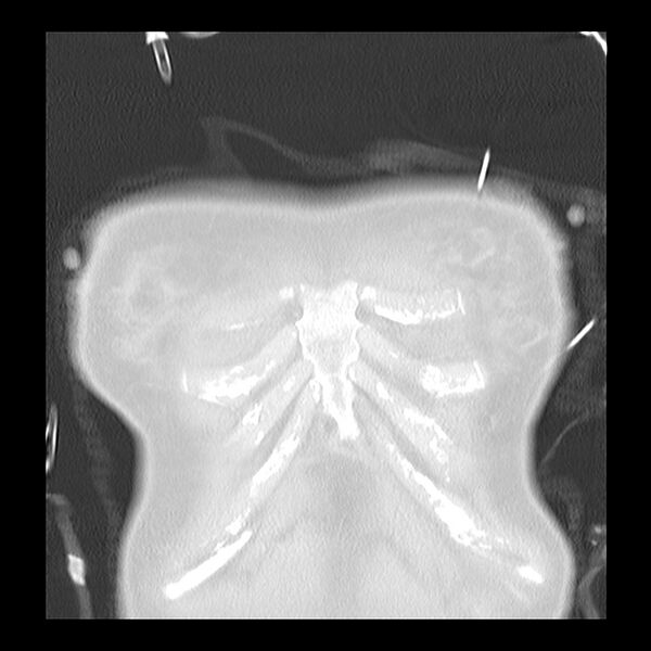 File:Acute pulmonary edema on CT (Radiopaedia 33582-34672 Coronal lung window 1).jpg