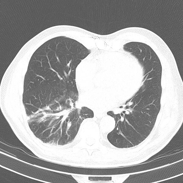 File:Acute pulmonary embolism (Radiopaedia 81677-95570 Axial lung window 29).jpg