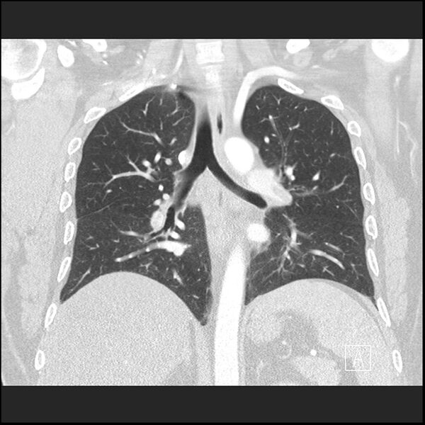 File:Acute pulmonary embolism with pulmonary infarct (Radiopaedia 73062-83768 Coronal lung window 45).jpg