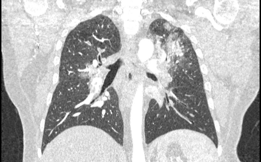 Acute pulmonary embolism with pulmonary infarcts (Radiopaedia 77688-89908 Coronal lung window 59).jpg