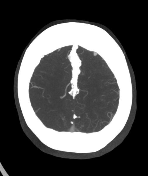 File:Acute right MCA M1 occlusion (Radiopaedia 62268-70454 Axial Phase 1 7).jpg