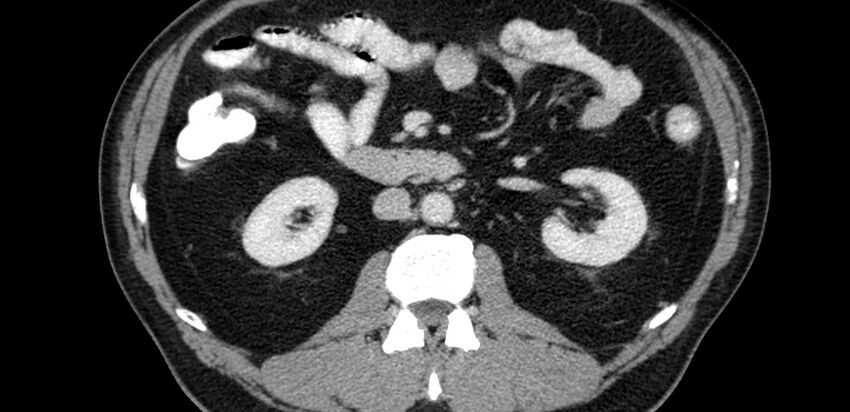 Acute sigmoid colon diverticulitis (Radiopaedia 55507-61976 Axial C+ portal venous phase 2).jpg