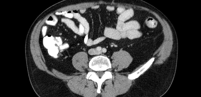 Acute sigmoid colon diverticulitis (Radiopaedia 55507-61976 Axial C+ portal venous phase 47).jpg