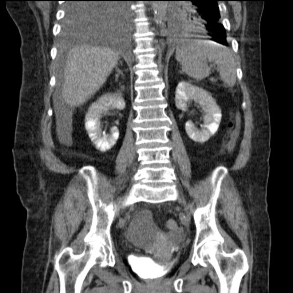 File:Acute tubular necrosis (Radiopaedia 28077-28334 G 56).jpg