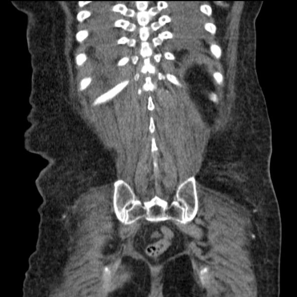 File:Acute tubular necrosis (Radiopaedia 28077-28334 G 70).jpg