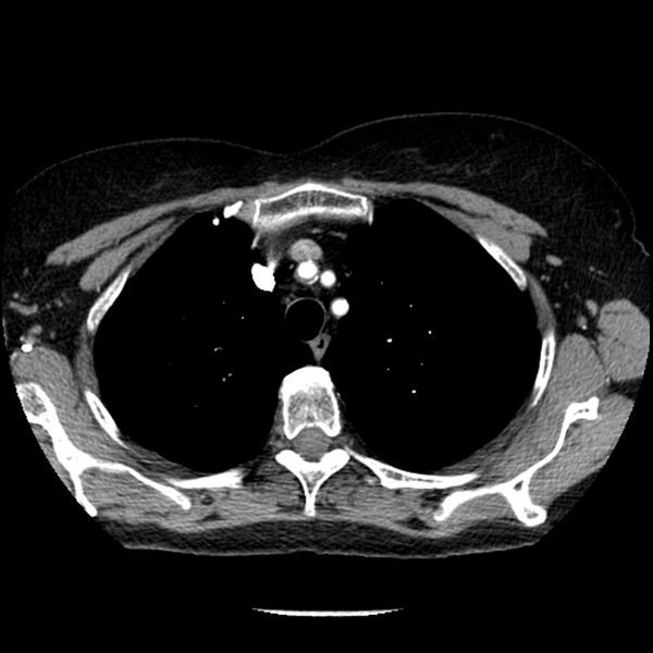 File:Adenocarcinoma of the lung (Radiopaedia 41015-43755 Axial C+ portal venous phase 25).jpg