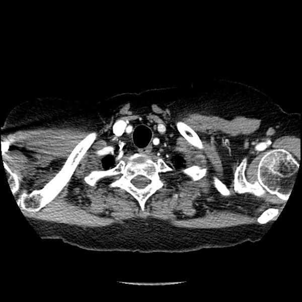 File:Adenocarcinoma of the lung (Radiopaedia 41015-43755 Axial C+ portal venous phase 7).jpg