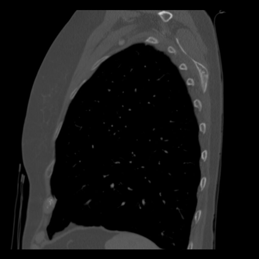 Adenocarcinoma of the lung (Radiopaedia 41015-43755 Sagittal bone window 88).jpg