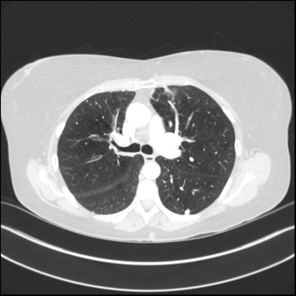 File:Adenocarcinoma of the lung (Radiopaedia 44205-47803 Axial lung window 39).jpg