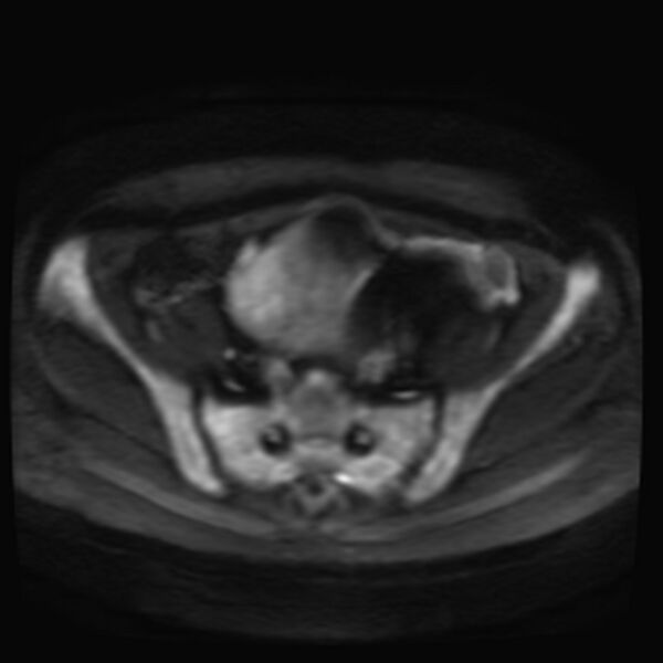 File:Adenomyosis on MRI (Radiopaedia 29328-29780 Axial DWI 3).jpg