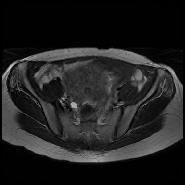 File:Adenomyosis on MRI (Radiopaedia 29328-29780 Axial T2 2).jpg