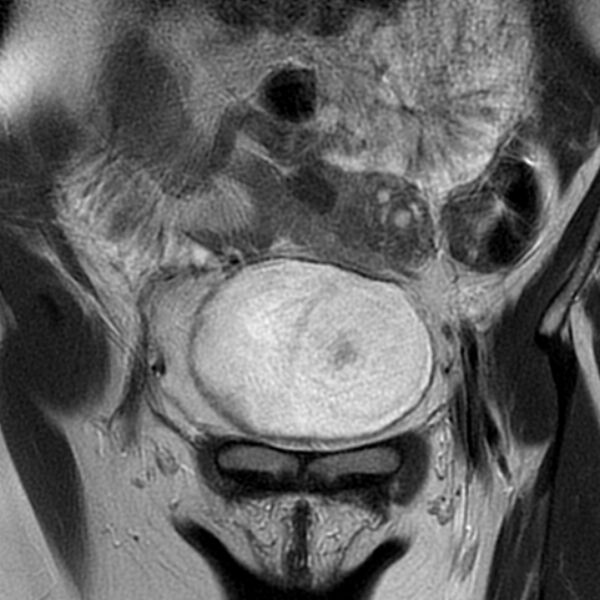File:Adenomyosis within a septate uterus (Radiopaedia 69963-79981 Coronal T2 3).jpg