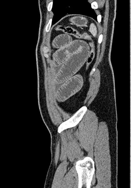 File:Adhesional small bowel obstruction (Radiopaedia 58900-66131 Sagittal C+ portal venous phase 222).jpg