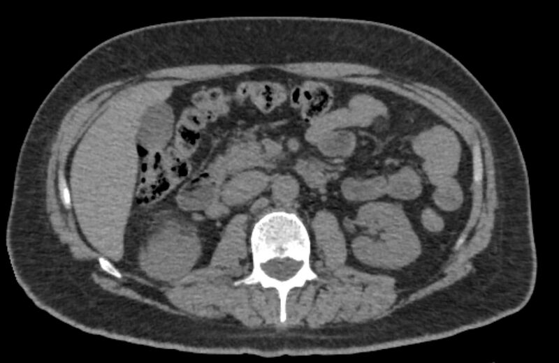 File:Adrenal myelolipoma (Radiopaedia 65240-74253 Axial non-contrast 60).jpg