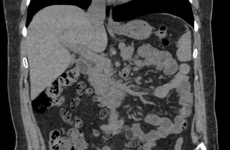 File:Adrenal myelolipoma (Radiopaedia 65240-74253 Coronal non-contrast 3).jpg
