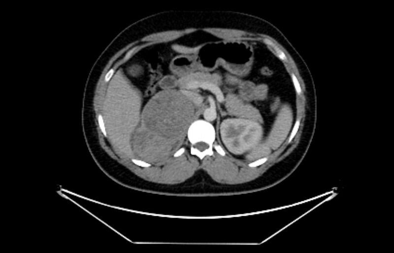 File:Adrenocortical carcinoma (Radiopaedia 80134-93438 Axial C+ portal venous phase 42).jpg
