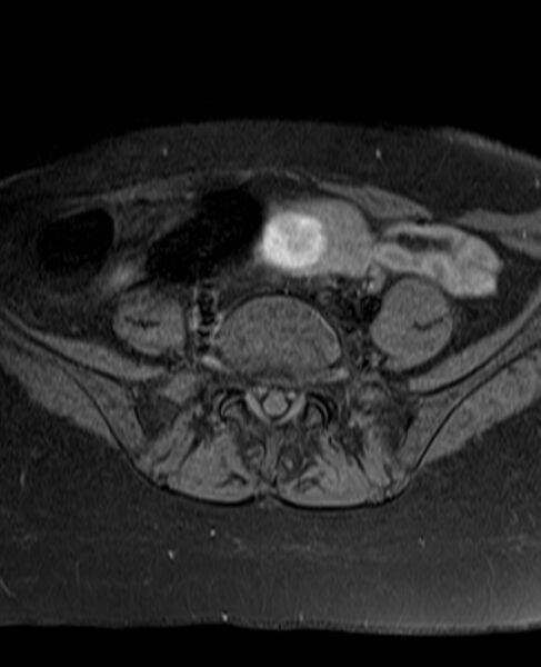File:Adult granulosa cell tumor of the ovary (Radiopaedia 71581-81950 Axial T1 fat sat 5).jpg